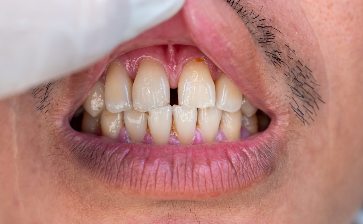 Huge gap between the front teeth or incisors. Diastema.