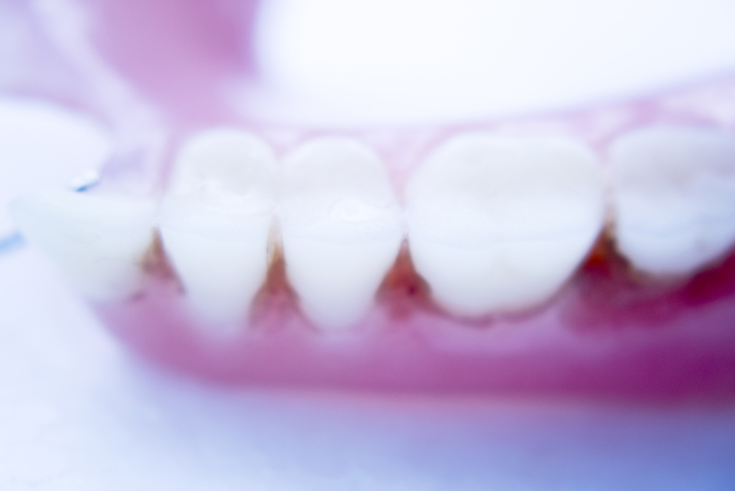 Prosthetic Dental Partial Dentures